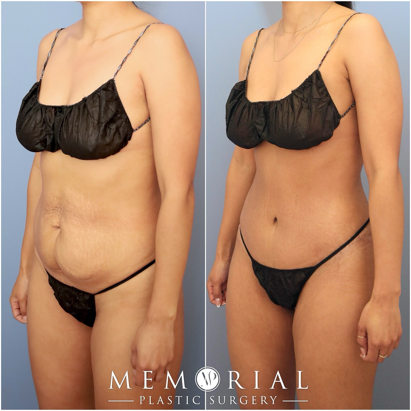 Beautiful & natural results at 7 months post-op 🔥🔥
Procedure: Tummy Tuck, Lipo360 + Skinny BBL (Pre-Sx Wt: 130 lbs Ht: 5’3 BMI: 23)
#mommymakeover #beforeandafter #houstonplasticsurgeon #tummytuck #plasticsurgery @memorialplasticsurgery
