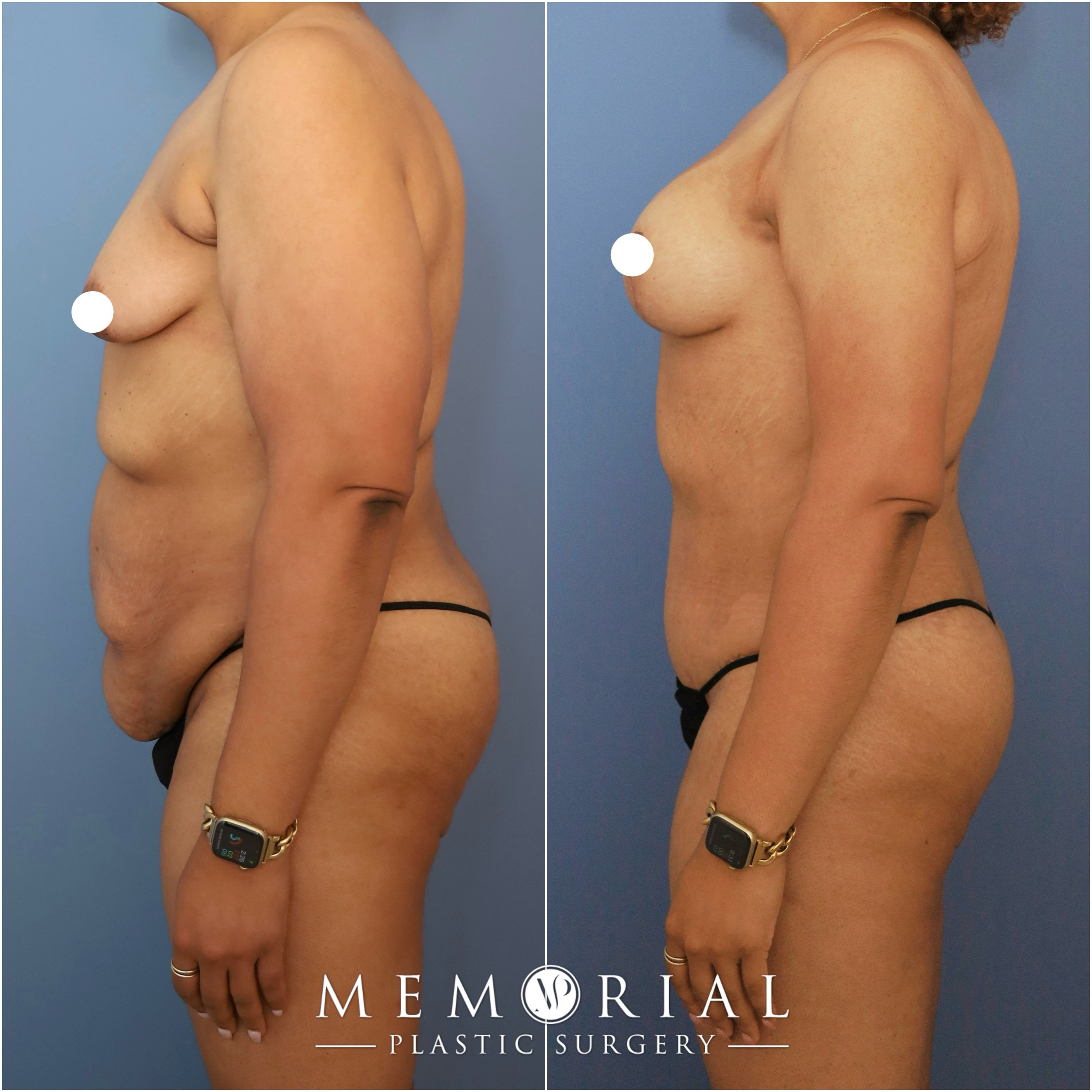 Following an 85-lbs weight loss and 3 children, my beautiful patient was ready for her transformation.
She was healthy, active and at her goal weight, and we addressed all areas that she was concerned about: abdomen, back, breasts, and arms, in order to complete her journey.👌🏼
Procedures (performed in 2 stages): Circumferential Lower Body Lift, Lipo 360, Breast Lift w/ implants (Aug-Pexy, 295cc) & Arm Lift (Brachioplasty).
📍 @memorialplasticsurgery | #houston #drvasilakis #weightloss #majorweightloss #mommymakeover