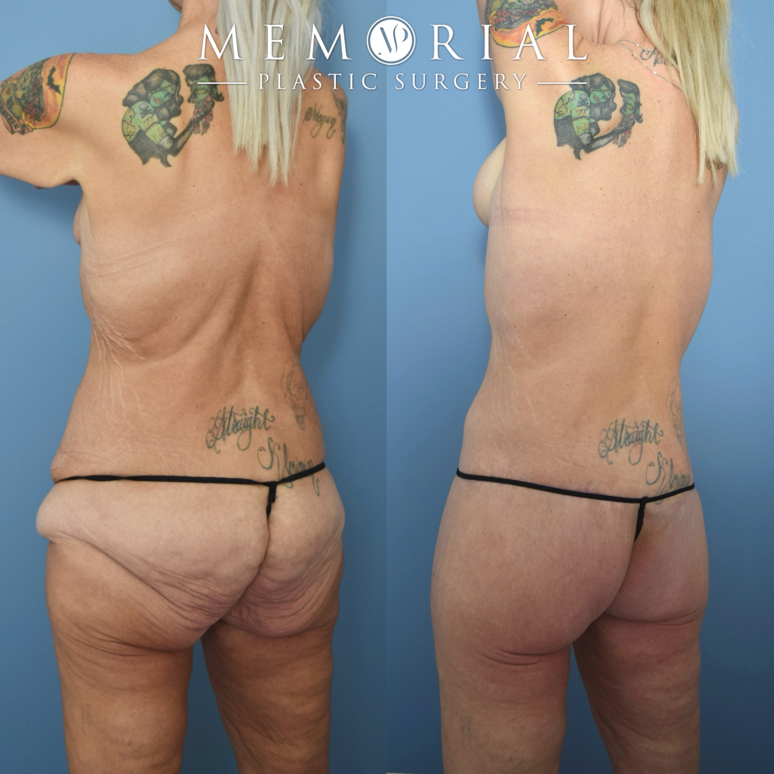The power of Body Lift 💪🏽
My beautiful patient lost 120 lbs following gastric bypass surgery. She did a great job at maintaining her goal weight and was ready for her body contouring surgery.
This is a great example of the dramatic effect that the posterior body lift has in tightening the entire torso. The scar can be easily hidden below thin underwear and swimwear 👏🏼👏🏼
📍 @memorialplasticsurgery | #drvasilakis #houstonplasticsurgery #bodylift #majorweightloss #bodylift