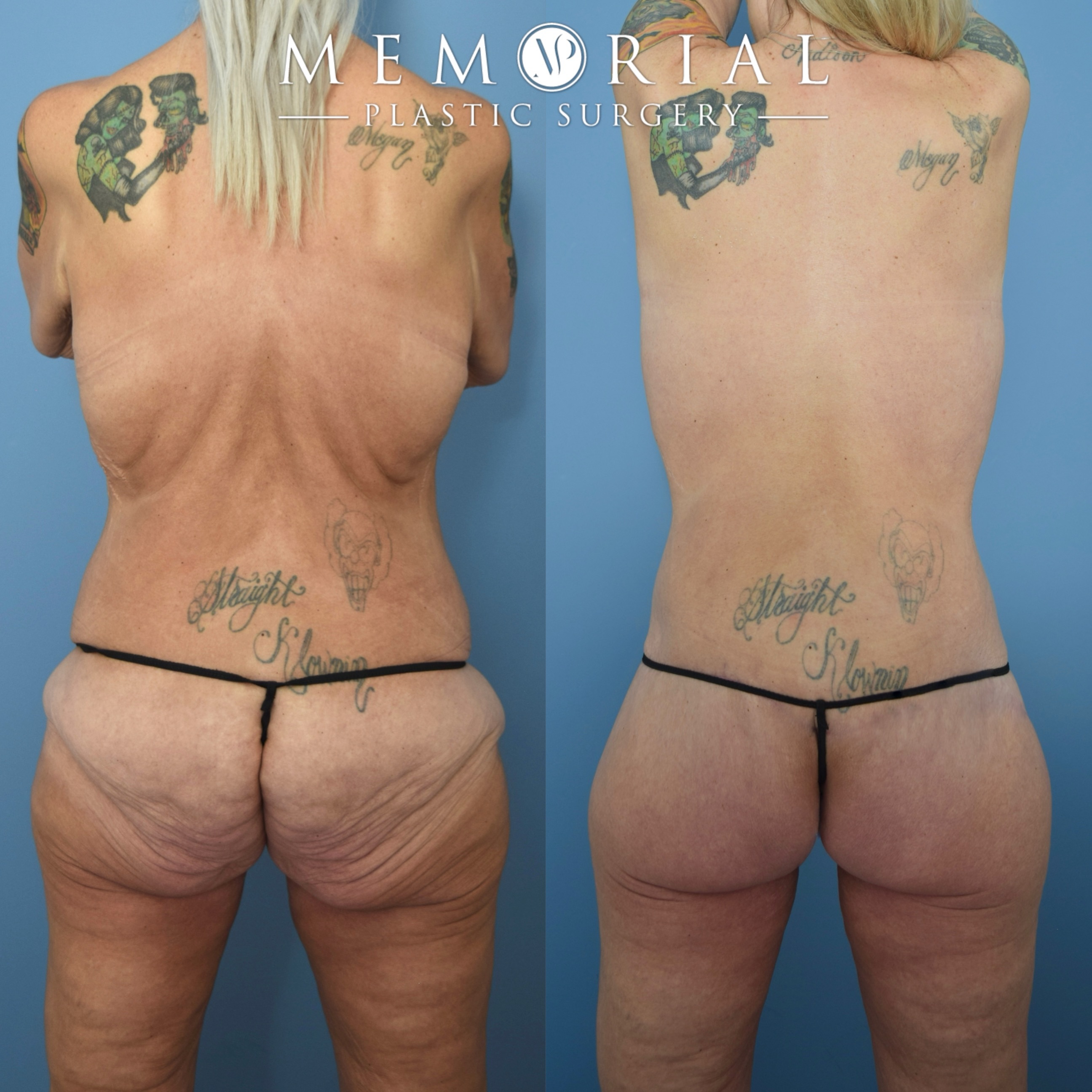 The power of Body Lift 💪🏽
My beautiful patient lost 120 lbs following gastric bypass surgery. She did a great job at maintaining her goal weight and was ready for her body contouring surgery.
This is a great example of the dramatic effect that the posterior body lift has in tightening the entire torso. The scar can be easily hidden below thin underwear and swimwear 👏🏼👏🏼
📍 @memorialplasticsurgery | #drvasilakis #houstonplasticsurgery #bodylift #majorweightloss #bodylift